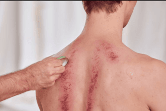 Kerokan menjadi alternatif pengobatan masuk angin.