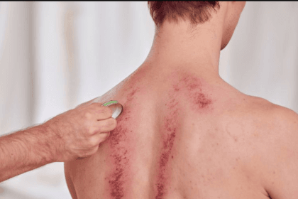 Kerokan menjadi alternatif pengobatan masuk angin.