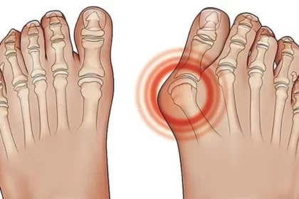 Asam urat merupakan penyakit yang menyerang dengan gejala nyeri.