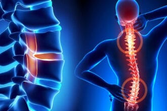 Saraf terjepit perlu diwaspadai.