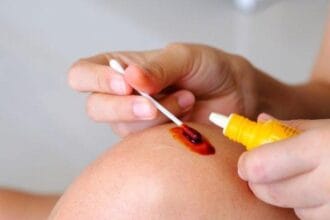 Obat merah banyak dicari saat mengalami luka.