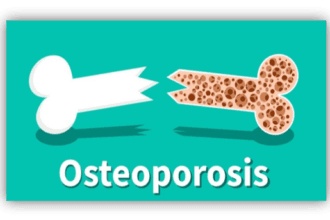 Penyakit osteoporosis perlu diwaspadai.