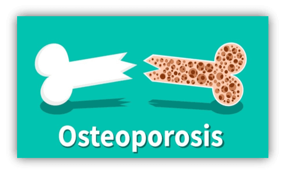 Penyakit osteoporosis perlu diwaspadai.
