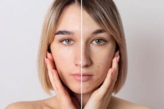 Hiperpigmentasi (Foto : Plasthetic Clinic)