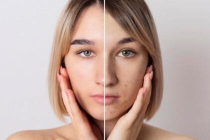 Hiperpigmentasi (Foto : Plasthetic Clinic)