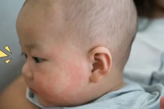 Penyebab dan Gejala Penyakit Kawasaki pada Anak