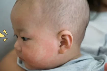 Penyebab dan Gejala Penyakit Kawasaki pada Anak