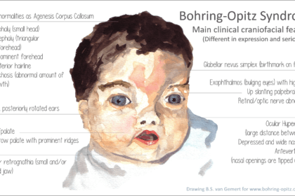 Hari Sindrom Bohring Opitz (Foto : Bohring Opitz Syndrome)