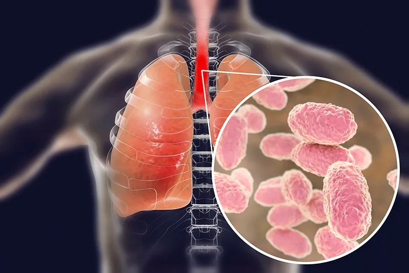 48629dinkes kota tangerang imbau orang tua waspadai pertussis pada anak 48629