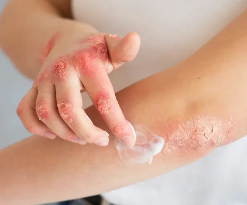 Kasus Kusta di Banten, Kabupaten Tangerang Tertinggi 339 Pasien 1 Kusta di Banten