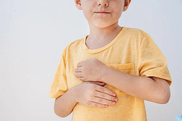 Ancaman KLB Campak di Banten Meningkat, Ribuan Kasus Suspek dan 6 Korban Jiwa 1 Campak di Banten